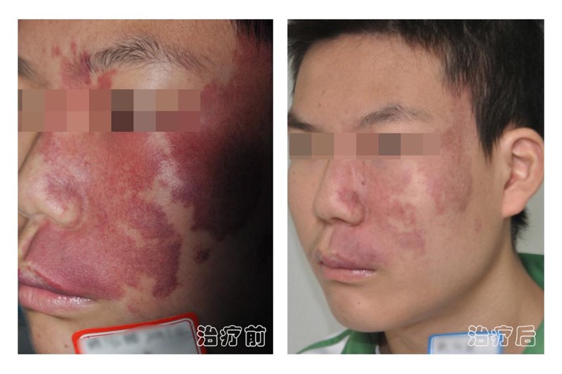 鲜红斑痣治疗